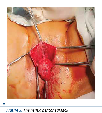 Figure 5. The hernia peritoneal sack