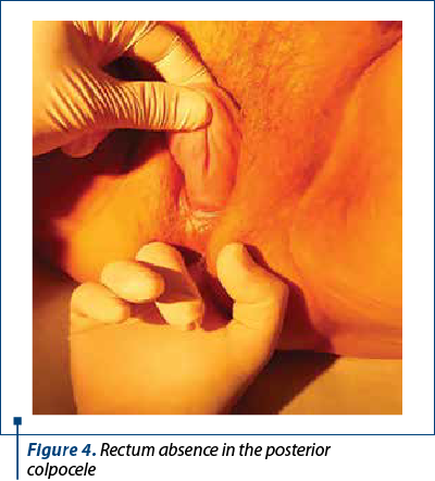 Figure 4. Rectum absence in the posterior 