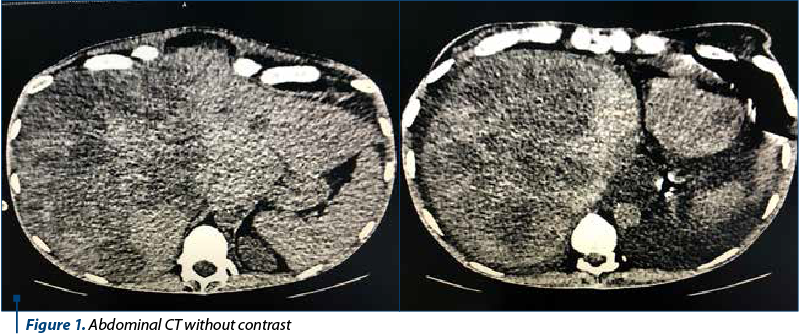 Figure 1. Abdominal CT without contrast