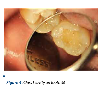 Figure 4. Class I cavity on tooth 46 