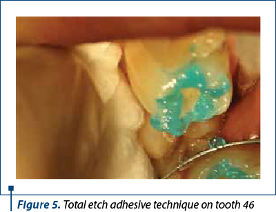 Figure 5. Total etch adhesive technique on tooth 46  