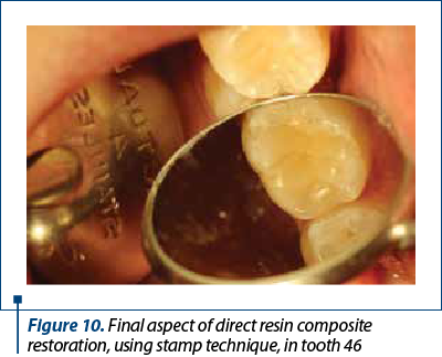 Figure 10. Final aspect of direct resin composite restoration, using stamp technique, in tooth 46 