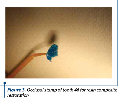 Figure 3. Occlusal stamp of tooth 46 for resin composite restoration