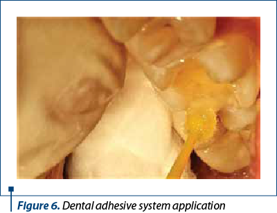 Figure 6. Dental adhesive system application 