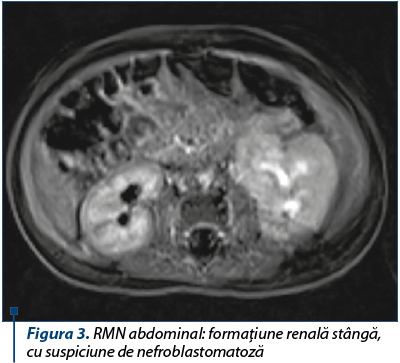 Figura 3. RMN abdominal: formaţiune renală stângă, cu suspiciune de nefroblastomatoză