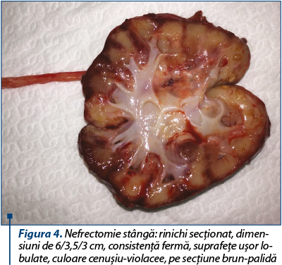 Figura 4. Nefrectomie stângă: rinichi secţionat, dimen­siuni de 6/3,5/3 cm, consistenţă fermă, suprafeţe uşor lo­­bu­la­te, culoare cenuşiu-violacee, pe secţiune brun-palidă