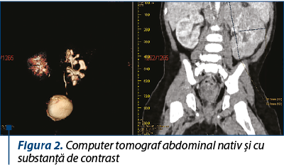 Figura 2. Computer tomograf abdominal nativ şi cu substanţă de contrast