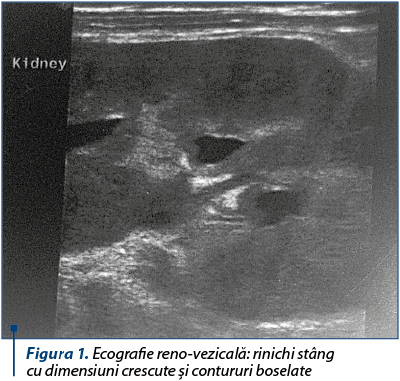 Figura 1. Ecografie reno-vezicală: rinichi stâng  cu dimensiuni crescute şi contururi boselate