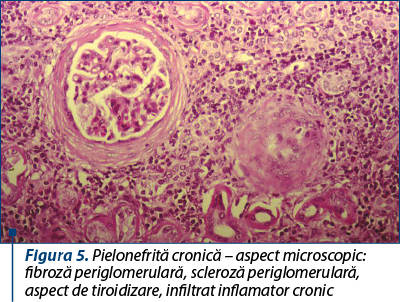 Figura 5. Pielonefrită cronică – aspect microscopic: fibroză periglomerulară, scleroză periglomerulară, aspect de tiroidizare, infiltrat inflamator cronic