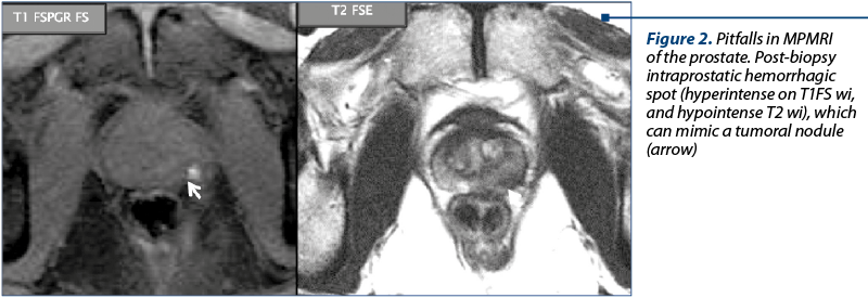 Figure 2. Pitfalls in MPMRI of the prostate. Post-biopsy intraprostatic hemorrhagic spot (hyperintense on T1FS wi, and hypointense T2 wi), which can mimic a tumoral nodule (arrow)