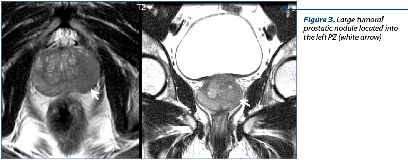 Figure 3. Large tumoral prostatic nodule located into the left PZ (white arrow)
