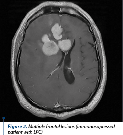 Figure 2. Multiple frontal lesions (immunosupressed patient with LPC)
