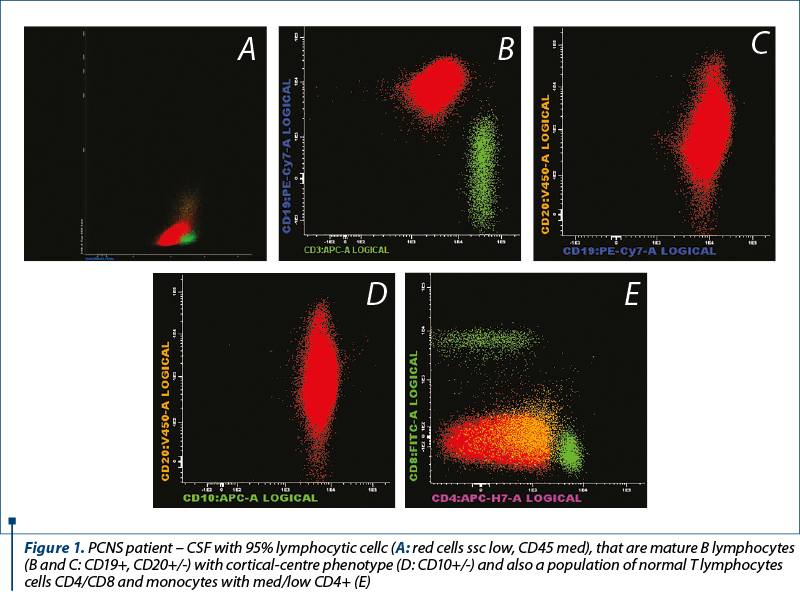 Figure 1. PCNS patient – CSF with 95% lymphocytic cellc (A: red cells ssc low, CD45 med), that are mature B lymphocytes (B and C: CD19+, CD20+/-) with cortical-centre phenotype (D: CD10+/-) and also a population of normal T lymphocytes cells CD4/CD8 and monocytes with med/low CD4+ (E)