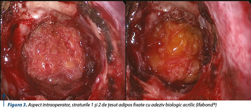 Figura 3. Aspect intraoperator, straturile 1 şi 2 de ţesut adipos fixate cu adeziv biologic acrilic (Ifabond®)