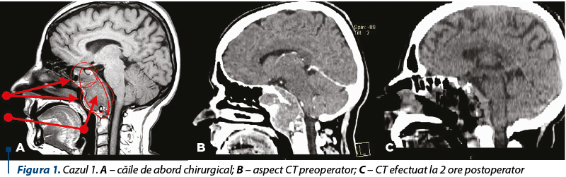 Figura 1. Cazul 1. A – căile de abord chirurgical; B – aspect CT preoperator; C – CT efectuat la 2 ore postoperator