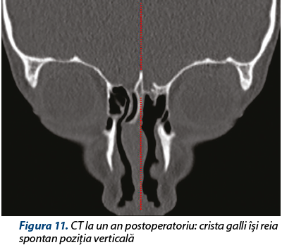 Figura 11. CT la un an postoperatoriu: crista galli îşi reia spontan poziţia verticală