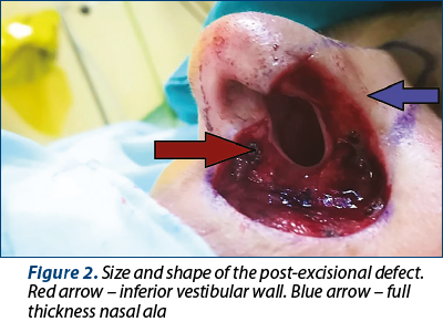 Figure 2. Size and shape of the post-excisional defect. Red arrow – inferior vestibular wall. Blue a