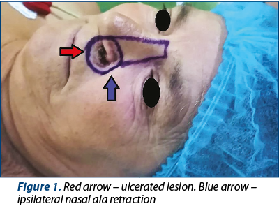 Figure 1. Red arrow – ulcerated lesion. Blue arrow – ipsilateral nasal ala retraction