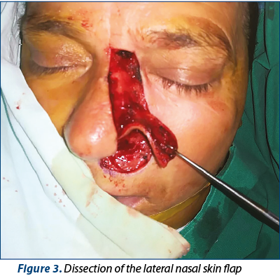 Figure 3. Dissection of the lateral nasal skin flap