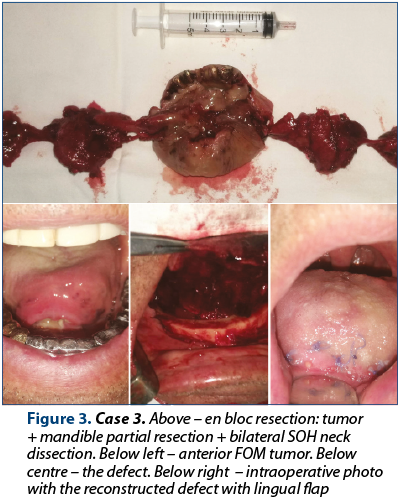Figure 3. Case 3. Above – en bloc resection: tumor + mandible partial resection + bilateral SOH neck dissection. Below left – anterior FOM tumor. Below centre – the defect. Below right  – intraoperative photo with the reconstructed defect with lingual flap
