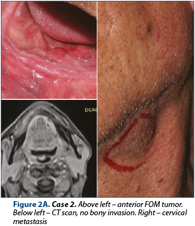 Figure 2A. Case 2. Above left – anterior FOM tumor. Below left – CT scan, no bony invasion. Right – cervical metastasis