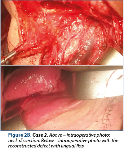 Figure 2B. Case 2. Above – intraoperative photo: neck dissection. Below – intraoperative photo with the reconstructed defect with lingual flap 