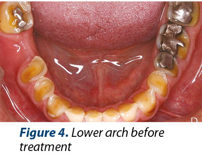 Figure 4. Lower arch before treatment