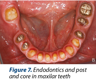 Figure 7. Endodontics and post and core in maxilar teeth