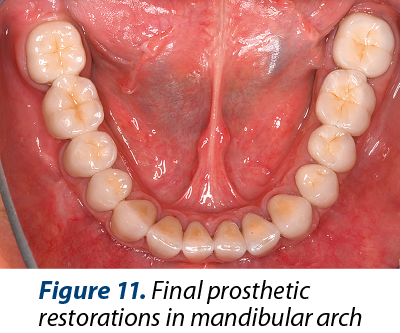 Figure 11. Final prosthetic restorations in mandibular arch