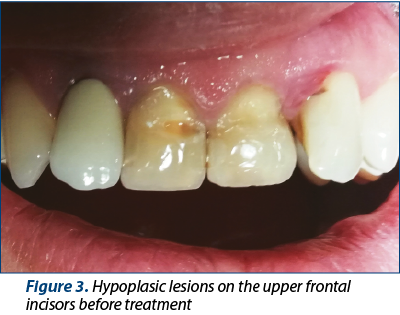 Figure 3. Hypoplasic lesions on the upper frontal incisors before treatment