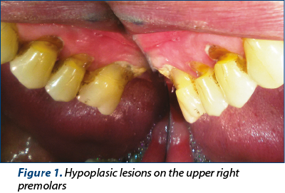 Figure 1. Hypoplasic lesions on the upper right premolars
