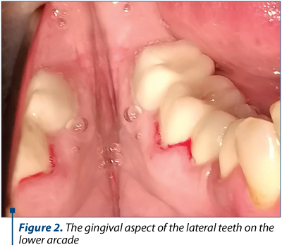 Figure 2. The gingival aspect of the lateral teeth on the lower arcade