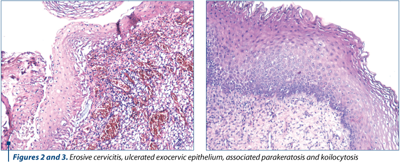 Figures 2 and 3. Erosive cervicitis, ulcerated exocervic epithelium, associated parakeratosis and ko