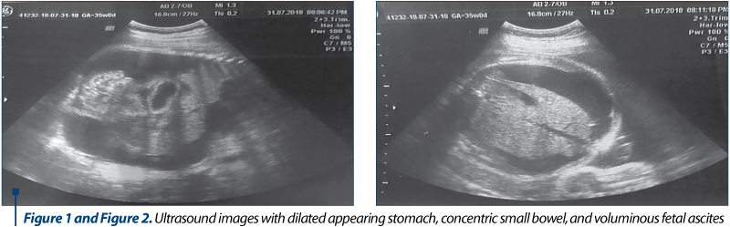 Figure 1 and Figure 2. Ultrasound images with dilated appearing stomach, concentric small bowel, andFigure 1 and Figure 2. Ultrasound images with dilated appearing stomach, concentric small bowel, and voluminous fetal ascites 
