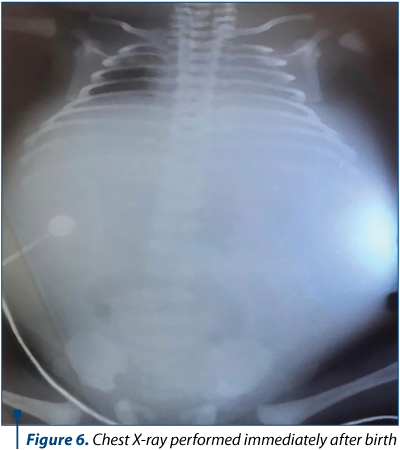Figure 6. Chest X-ray performed immediately after birth