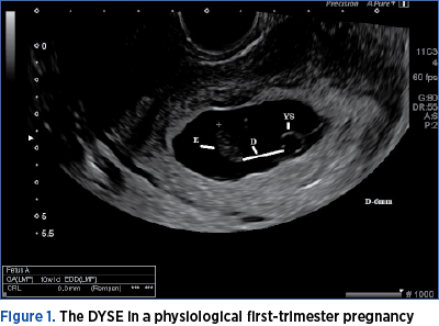 Figure 1. The DYSE in a physiological first-trimester pregnancy