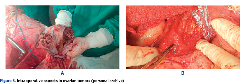Figure 5. Intraoperative aspects in ovarian tumors (personal archive)