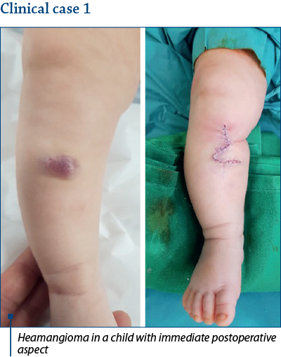 Heamangioma in a child with immediate postoperative aspect
