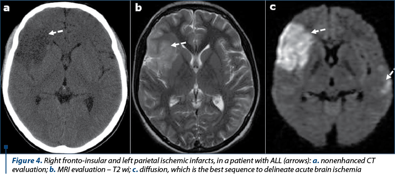 Figure 4. Right fronto-insular and left parietal ischemic infarcts, in a patient with ALL (arrows): a. nonenhanced CT evaluation; b. MRI evaluation – T2 wi; c. diffusion, which is the best sequence to delineate acute brain ischemia