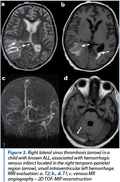 Figure 3. Right lateral sinus thrombosis (arrow) in a child with known ALL, associated with hemorrhagic venous infarct located in the right temporo-parietal region (arrow), small intraventricular left hemorrhage. MRI evaluation: a. T2; b., d. T1; c. venous MR angiography – 2D TOF: MIP reconstruction