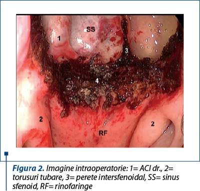 Figura 2. Imagine intraoperatorie: 1= ACI dr., 2= torusuri tubare, 3= perete intersfenoidal, SS= sinus sfenoid, RF= rinofaringe