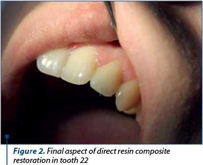 Figure 2. Final aspect of direct resin composite restoration in tooth 22 