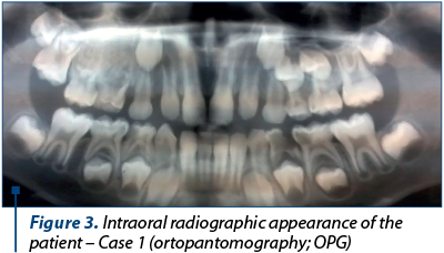 Figure 3. Intraoral radiographic appearance of the patient 