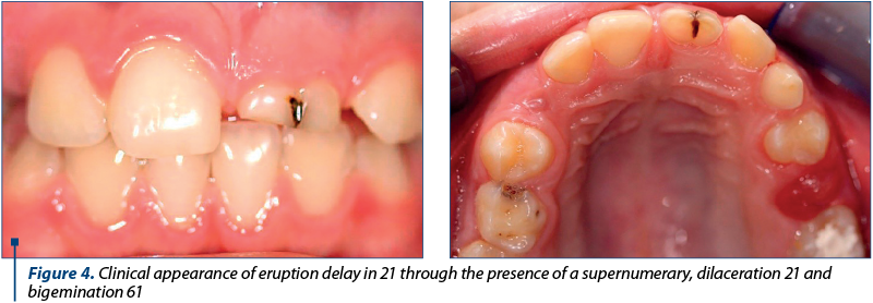 Figure 4. Clinical appearance of eruption delay in 21 through the presence of a supernumerary, dilac