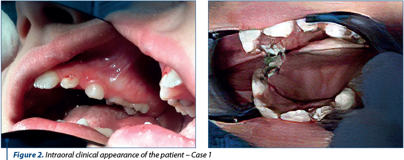 Figure 2. Intraoral clinical appearance of the patient – Case 1