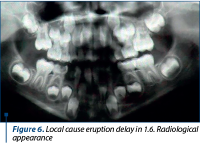 Figure 6. Local cause eruption delay in 1.6. Radiological appearance 