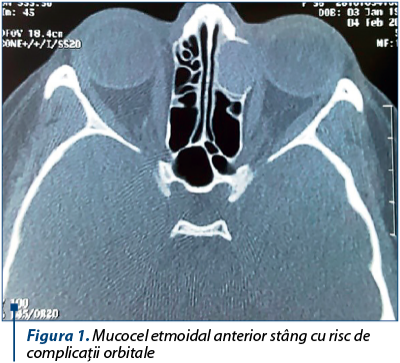 Figura 1. Mucocel etmoidal anterior stâng cu risc de complicaţii orbitale 