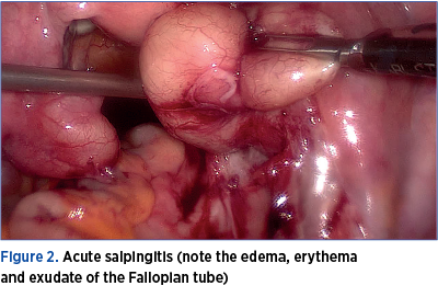 Figure 2. Acute salpingitis (note the edema, erythema  and exudate of the Fallopian tube) 