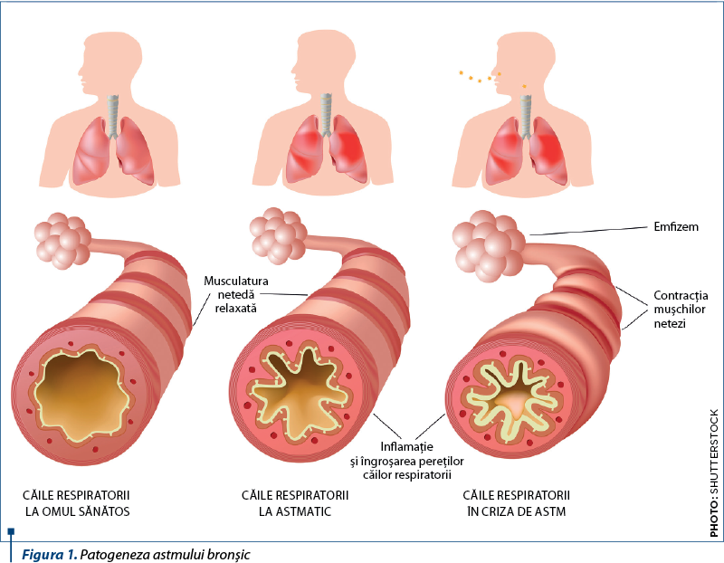 Figura 1. Patogeneza astmului bronşic