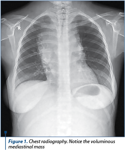 Figure 1. Chest radiography. Notice the voluminous mediastinal mass